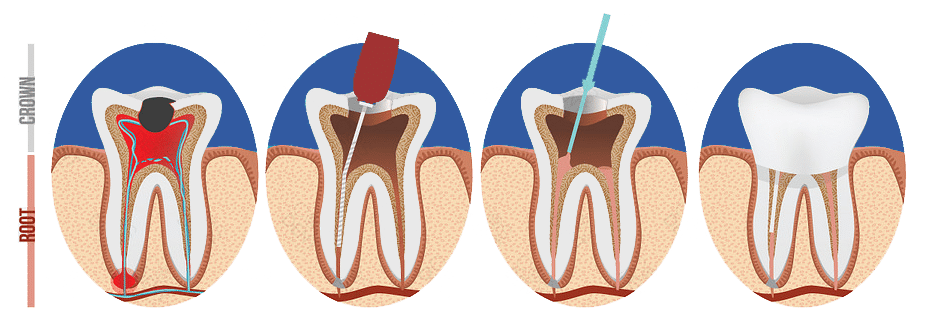 root canal papatoetoe dental