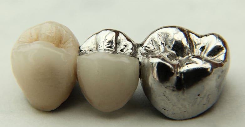 dental bridges papatoetoe