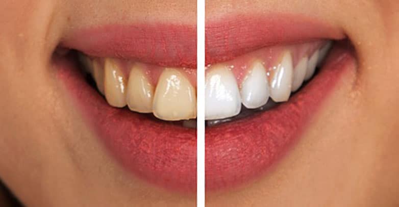 tooth whitening dentist papatoetoe